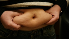 Stay in shape with plastic surgery after bariatric procedure