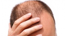 New drug restores hair growth in human trials