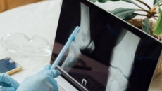 What women need to know about bone health