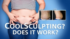 Want a great summer body? Find out more about Coolsculpting