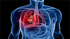 BC Scientists Develop Lifesaving Diagnostic Tool for Lung Cancer Patients