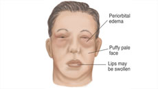 What is Nephrotic Syndrome (NS)?