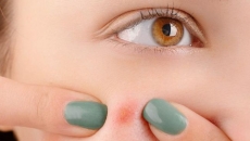 Pop these myths not your pimples!