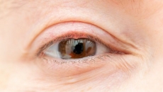 7 ways to treat or get rid of a stye