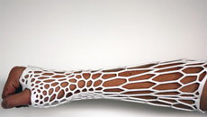 Now, 3D-printed plaster cast to heal wound faster