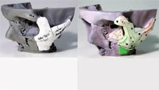 3D printing repairs British accident victim's face