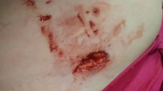 Mother Of Girl Bitten By Saskatoon Police Dog Blames Handler, Not Animal