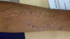 Blue Whale Challenge Enters Assam: 17-year-old Tries To Commit Suicide