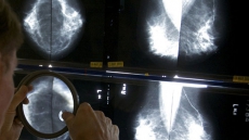 Breast Biopsy Accuracy Varies, Especially With Pre-cancer Conditions, Experimental Study Says