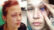 Canadian Model Catt Gallinger Partially Loses Her Vision After Tattooing Eyeball; Writes A Facebook 