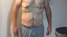 Winnipeg Man Who Lost 200 Pounds Fundraises For Surgery To Remove Excess Skin