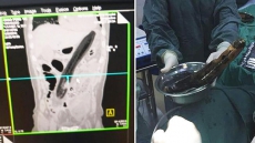 Massive Fail: Chinese Man Uses Eggplant To 'Cure' Constipation