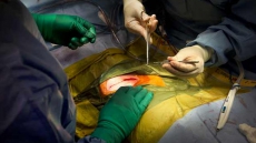 As End-stage Kidney Disease Rates Rise, Demand For Organ Transplants Grows: Report