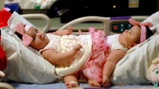 Surgery Separates Infant Conjoined Twins In Texas