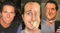 Tumour Has Left This 38-year-old Man Half-Faced!
