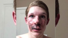 'It Lit My Kid's Face On Fire:' Calls For Ban On Selling E-Cigarettes To Minors