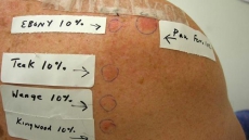 Got A Rash From Your Belt Buckle Or Ring? You Could Have Contact Dermatitis