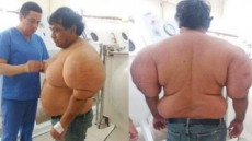 This Diver Was Left Looking Like A Balloon After Rising From The Depths Too Fas