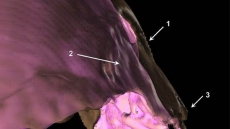 Oldest evidence of human brain damage found