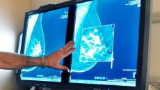 Study Questions Value Of Mammograms, Breast Cancer Screening