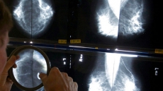 Early Stage Breast Cancer Patients Getting Too Many Imaging Tests: Study