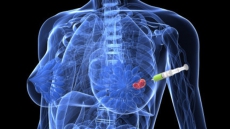 Gene behind benign breast tumours identified