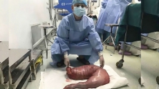 Constipated For 22 Years, Chinese Man Has 13kg Of Poop Removed From His Body