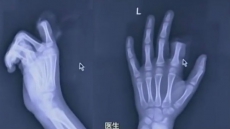 Asked Not To Use Smartphone, Chinese Kid Cuts Off Own Finger