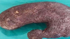 Bizarre! Doctors Remove Massive Lump Of Hair From 16-Year-Old Girl's Stomach In Dehradun