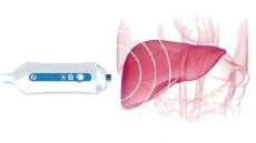 Fibroscan can diagnose liver stiffness in Hepatitis cases