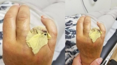 Woman Has Finger Ripped Off At West Edmonton Mall Waterslide