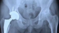 Premature babies at greater risk of future hip replacements