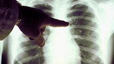 'Lung disease linked to diabetes under-diagnosed in India'