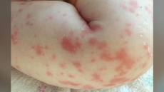 London, Ont. Baby Girl Suffered Multiple Organ Failure After Hot Tub Birth: Case Study