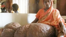 Mysterious Condition Leaves Woman With A Leg Weighing 60 Kg In Bangladesh