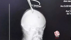 China: Woman With Scissors Stuck In Head Takes Bus To Hospital