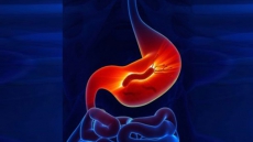 New method to diagnose stomach cancer developed