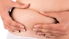Women bare bellies in bikinis to support Edmonton mom mocked over stretch marks