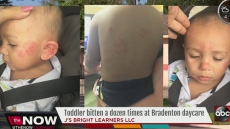Florida Toddler Bitten More Than A Dozen Times At Day Care