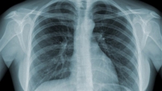 Potential treatment for drug-resistant TB discovered