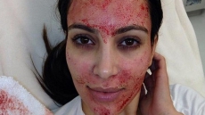 The Latest Fad In The Beauty World - Vampire Facial
