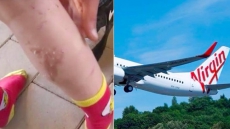 Virgin Airlines Staff Spills Boiling Water On 5-Year-Old, Leads To Second-Degree Burns